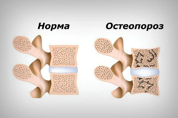 Osteoporoz: belgilari, sabablari va davolash