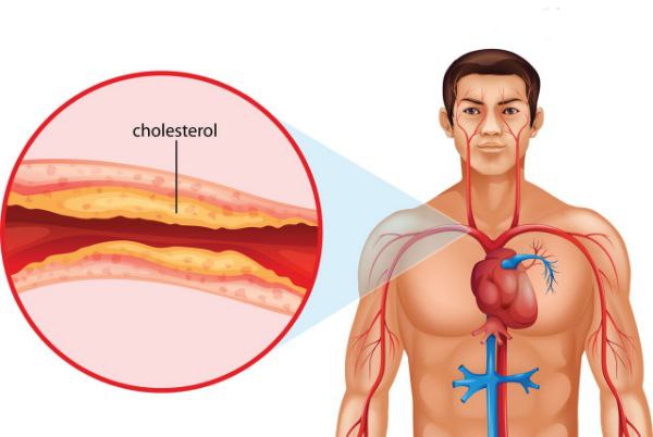 Xolesterin nima? uning darajasi qancha