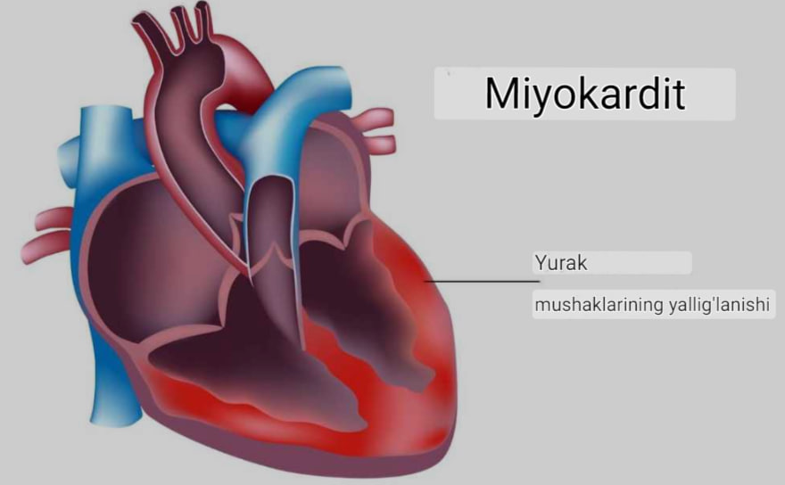 Miokardit: belgilari, sabablari va davolash usullari