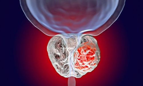 Prostata saratoni: belgilari va davolash usullari