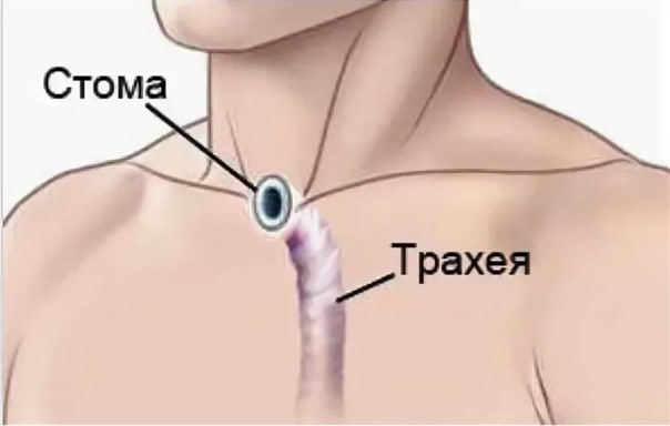 Traxeostomiya: Nafas olish tizimiga yordam va qo'llash jarayoni