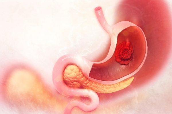 Oshqozon saratoni: belgilari, diagnostikasi va davolash usullari