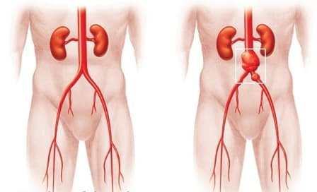 Aorta anevrizmasi: ta'rifi, belgilari va davolash