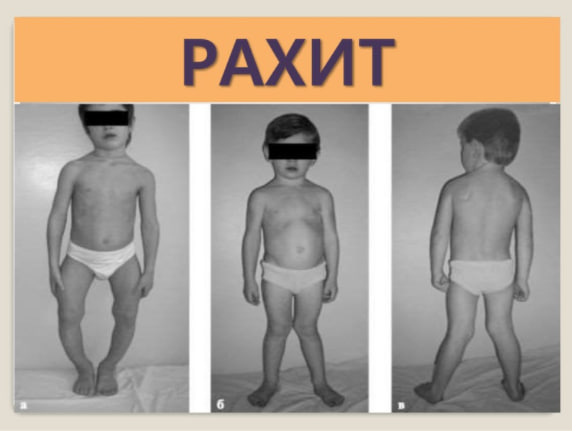 Bolalarda Raxit Kasalligi