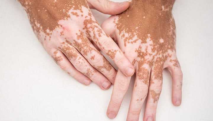 Oq Pes (Vitiligo) Kasalligi Haqida