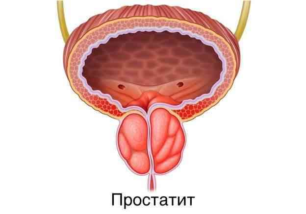 Prostatit kasalligi haqida