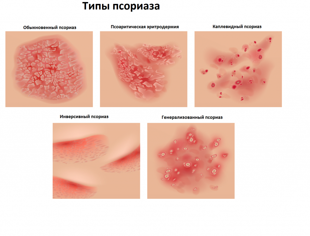 Psoriaz nima va u qanday yuzaga keladi