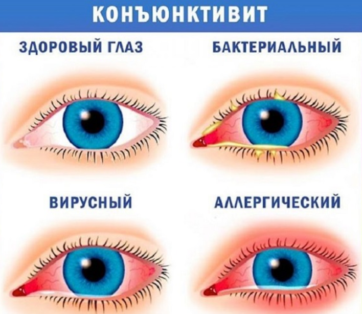 Konyuktivit nima? Sabablari, belgilari va davolash usullari