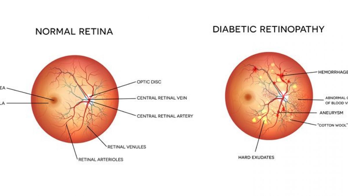 Retinopatiya nima: Sabablari va Davolash Usullari