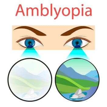 Ambliopiya (dangasa ko‘z) haqida