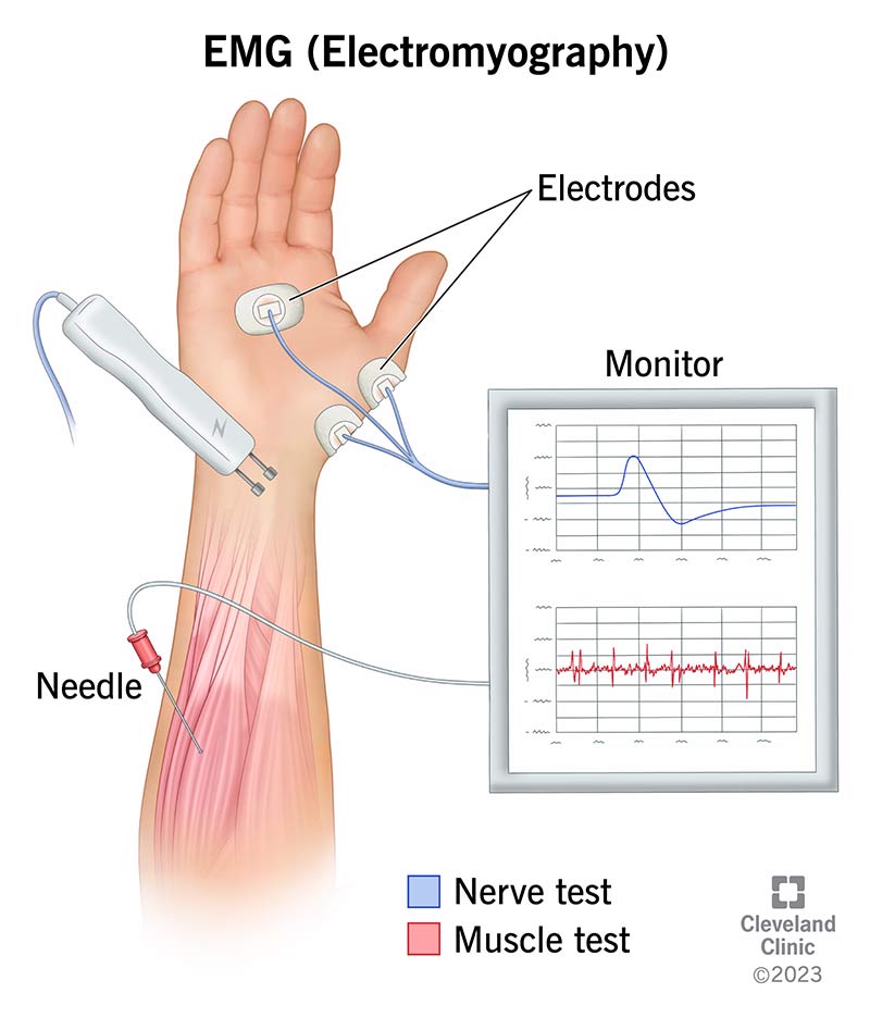 Elektromiyografiya (EMG) nima